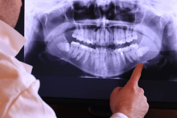 Best Emergency Dentist for Lost Fillings or Crowns in Minorca, LA