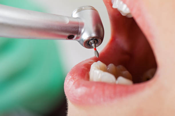 Best Emergency Dental Care for Abscessed Tooth in Minorca, LA